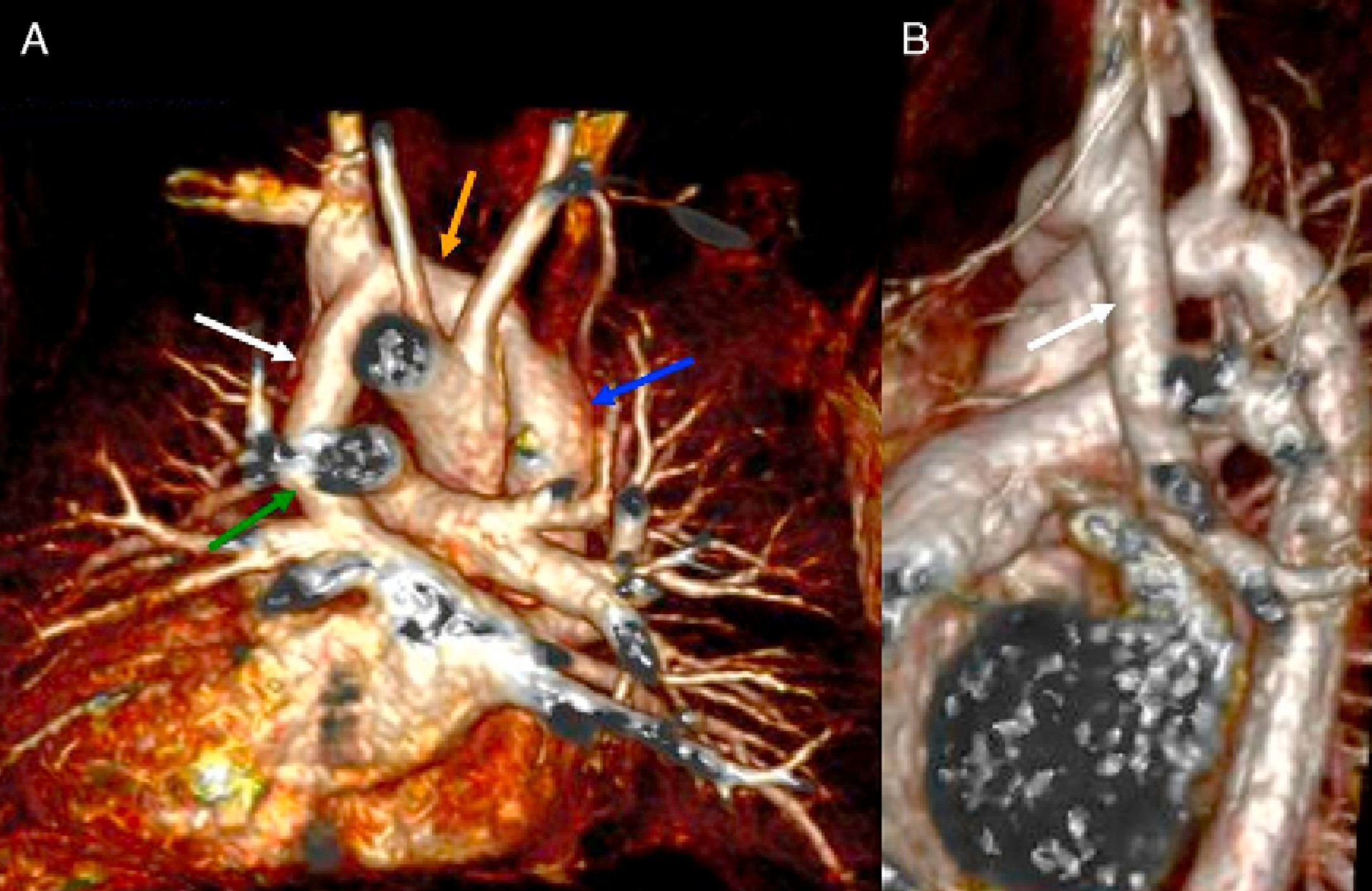 Partial anomalous pulmonary venous return | Revista Portuguesa de ...
