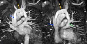 (A and B) Multiplanar angiographic reconstruction. Blue arrow – superior vena cava; yellow arrow – innominate vein; white arrow – anomalous vertical pulmonary vein; green arrow – left pulmonary veins.