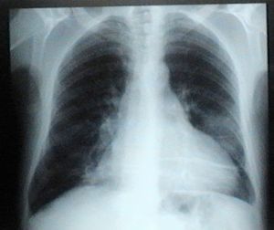 Chest X-ray in anteroposterior view.