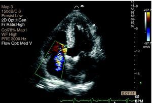 2D Doppler echocardiogram, showing tricuspid valve regurgitation.