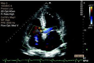 2D Doppler echocardiogram, showing turbulent flow compatible with perimembranous ventricular septal defect.