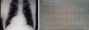 (A) Chest X-ray showing pericardial cyst projecting into the right costophrenic angle mimicking dextrocardia; (B) ECG without abnormalities suggesting dextrocardia.