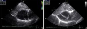 Echocardiography, subcostal view, with a 87 mm × 88 mm mass containing a septum, suggesting a diagnosis of large pericardial cyst.