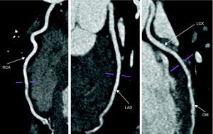 Cardiac computed tomography: multiplanar reconstructions ruling out significant coronary artery disease. LAD: left anterior descending artery; LCX: left circumflex artery; OM: obtuse marginal artery; RCA: right coronary artery.