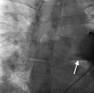 Pulmonary angiography. Using a 5-Fr pig tail catheter, pulmonary angiography was performed, which showed a moderately enlarged main PA.