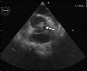 Transesophageal echocardiogram in short-axis view, showing a large vegetation (arrow) on a bicuspid aortic valve.