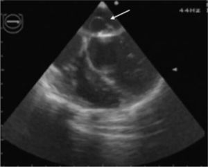 Transesophageal echocardiogram in 4-chamber view, showing an image suggestive of an abscess (arrow) on the anterior leaflet of the mitral valve.