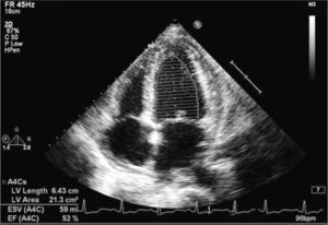 Echocardiogram after the patient's second visit to the emergency department, showing pericardial thickening and a small effusion of organized appearance.