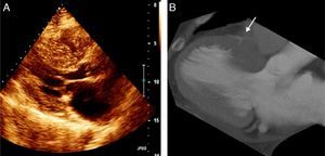 (A): Two-dimensional transthoracic echocardiogram in parasternal long-axis view in diastole; (B): the same view by multiplanar reconstruction (MPR) cardiac CT, 12 mm thickness, in diastole.