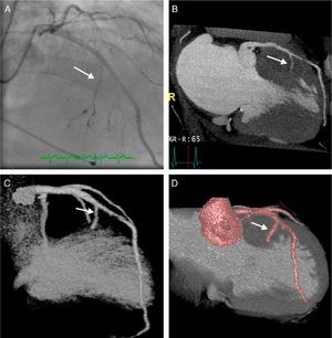 (A): Invasive coronary angiography in right anterior oblique view; (B): maximum intensity projection (MIP) CT coronary angiography, 12 mm thickness; (C) and (D): CT coronary angiography, three-dimensional reconstruction.