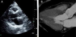 (A): Two-dimensional transthoracic echocardiogram in parasternal long-axis view in systole; (B): cardiac CT (MPR), 12 mm thickness, 3-chamber view, in systole (25% of the cardiac cycle).