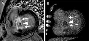 (A): Cardiac magnetic resonance (phase-sensitive inversion recovery), late enhancement study in short-axis view; (B): cardiac CT (MPR), 12 mm thickness, in the same view.