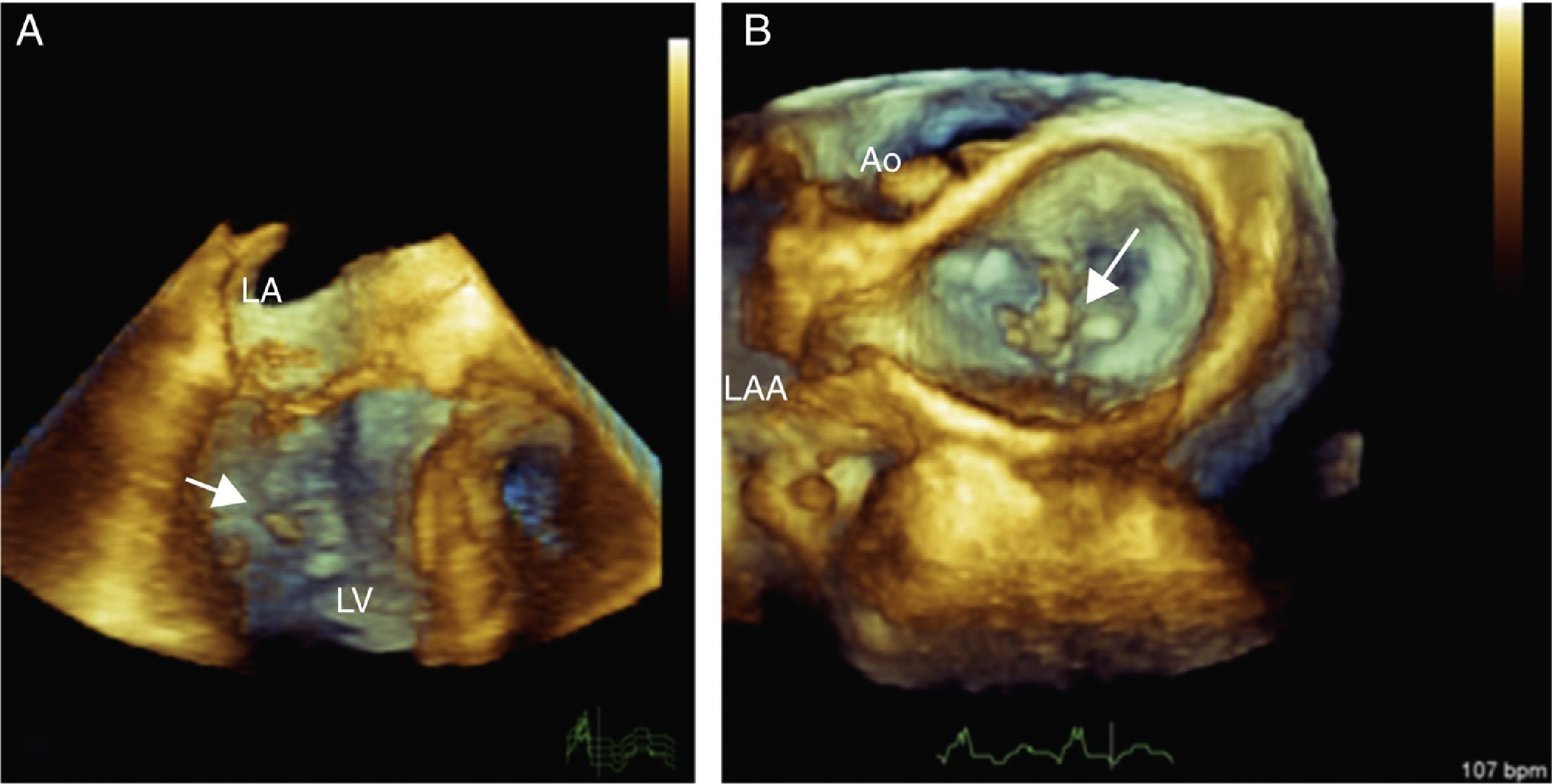 Ischemic rupture of the anterolateral papillary muscle | Revista ...