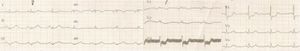 Electrocardiogram on admission demonstrating slight ST-segment elevation in the inferior leads, R>S in V1 and ST-segment depression in the anterior leads.