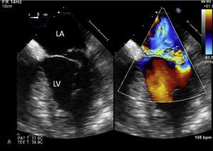 Two-dimensional transesophageal echocardiogram showing severe mitral regurgitation caused by posterior leaflet prolapse. LA: left atrium; LV: left ventricle.