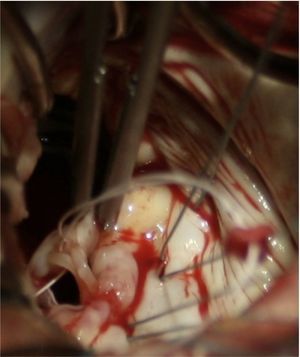 Intraoperative view showing the forceps holding the detached muscle head. The two primary cords connecting the muscle head to the edge of the posterior leaflet are clearly seen.