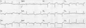 Electrocardiogram on admission with ST-segment elevation in anteroseptal and inferior leads.