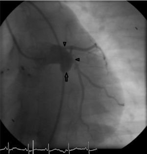 Control angiography nine months after the second intervention. The fistula is closed (arrow) and the origin of the LAD and Cx arteries is clearly seen in two separate ostia (arrowheads). The devices are still in place, visible on the left.