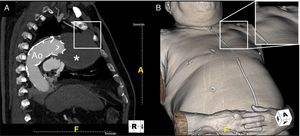 Pulsatile mass in the left chest wall noticed by the patient (B, with detail in box) and corresponding sagittal CT image (A) showing a giant aneurysm (*) measuring 70 mm×75 mm×95 mm expanding through the first left intercostal space (box).