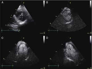 (A) Transthoracic echocardiogram, parasternal short-axis view. Contrast transthoracic echocardiogram: (B) parasternal short-axis view; (C) apical 4-chamber view; (D) apical 3-chamber view.