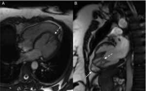 Cardiac magnetic resonance. Steady-state free precession images in horizontal long-axis view (A) and vertical long-axis view (B). Solid arrow: right ventricle. Dashed arrow: network of papillary muscles.