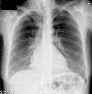 Chest X-ray.