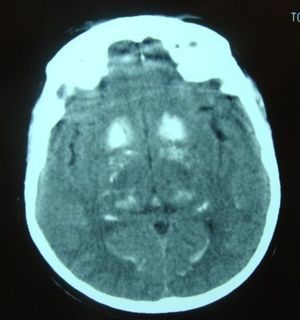 Cranial computed tomography scan.