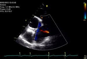 Color Doppler echocardiogram, left parasternal short-axis view, showing dilated pulmonary artery and flow from aorta to pulmonary artery.