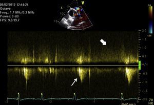 Echocardiogram, left parasternal short-axis view at the pulmonary valve level. Pulsed Doppler study immediately distal to the pulmonary valve guided by color Doppler (above), showing systolic flow through the pulmonary valve (narrow arrow) against a background of systolic–diastolic flow from aorta to pulmonary artery (wide arrow).