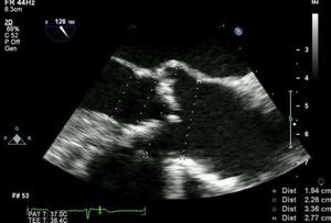 Measurement of aortic annulus diameter by transesophageal echocardiography.