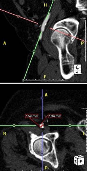 Measurement of minimum iliofemoral diameters by multidetector computed tomography.