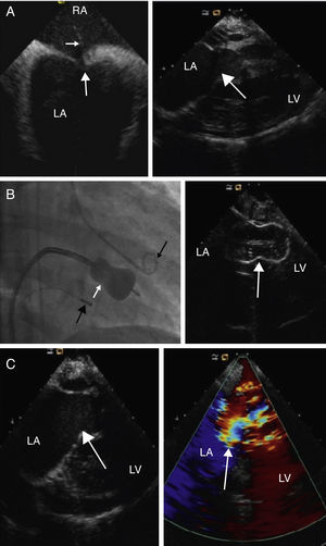 (A) Left: ICE image showing tenting of the interatrial septum (large white arrow) with the Mullins catheter and Brockenbrough needle (small white arrow). LA: left atrium; RA: right atrium. Right: ICE 2-chamber view after insertion of the ICE probe into the right ventricle (RV). Visualization of the mitral valve (white arrow) prior to percutaneous mitral balloon valvuloplasty. Left atrial enlargement and left ventricular function and dimensions can be assessed. (B) Percutaneous mitral balloon valvuloplasty. Angiographic and ICE visualization of the inflated Inoue balloon (white arrow). ICE catheter probe (large black arrow) is located in the RV and the pig-tail catheter (small black arrow) in the left ventricle. (C) Post-PMBV ICE assessment. Left: two-dimension assessment. Right: Doppler evaluation of the mitral valve showing 1+ mitral regurgitation.