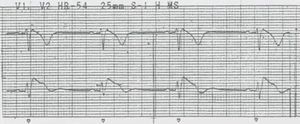 ECG with type 1 Brugada pattern.