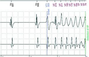 Home monitoring trace showing onset of ventricular fibrillation.