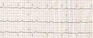 ECG showing second-degree 2:1 atrioventricular block with left bundle branch block.