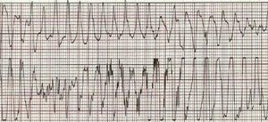 Torsade de pointes.