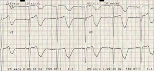 2:1 atrioventricular block (heart rate ±45 bpm) with prolonged QTc interval (±690 ms).