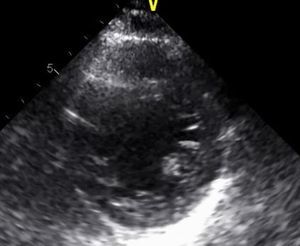 Echocardiogram: parasternal short-axis view showing images compatible with left ventricular non-compaction at the apex.