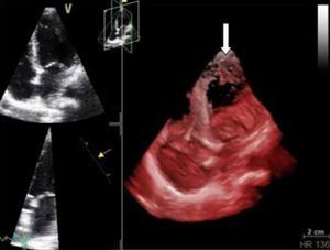 Echocardiogram. Left: apical 4-chamber view showing images compatible with left ventricular non-compaction at the apex; right: three-dimensional echocardiogram showing detail of trabeculations (arrow).