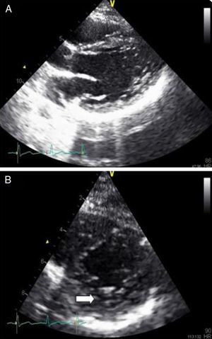 (A and B) Echocardiograms of the patient