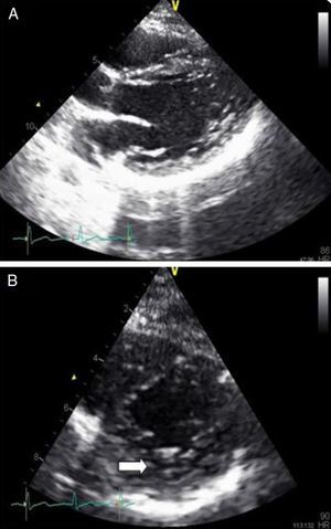 (A and B) Echocardiograms of the patient's children showing images compatible with left ventricular non-compaction.