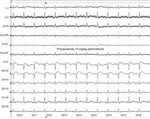 Type 1 ECG pattern following infusion of procainamide 10 mg/kg over a 10-minute period.