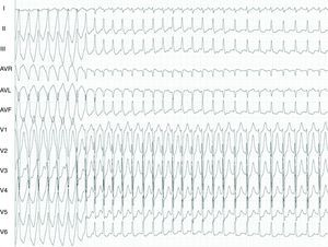 Twelve-lead ECG. In the first part of the tracing a broad QRS tachycardia is shown, with LBBB inferior axis morphology and negative QRS complex in aVL. After this run there is a change to a narrow QRS complex. Surface leads (I, II, III, aVF, V1 and V6), and electrograms recorded from the right ventricular apex and the coronary sinus.