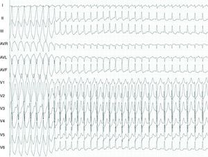 Simultaneous wide and narrow QRS complex tachycardia: what is the ...