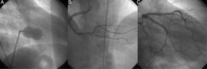 (A) Percutaneous mitral valvuloplasty following the Inoue technique. Last balloon inflation to 30mm; (B) right coronary angiogram performed during angina and inferior ST-segment elevation; (C) left coronary angiogram performed during angina and inferior ST-segment elevation.