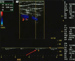 Triplex Doppler scan, revealing reversal of left vertebral artery flow (arrow).