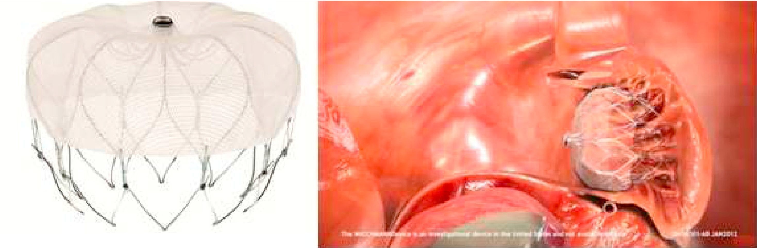 Percutaneous closure of the left atrial appendage for prevention of ...