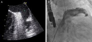Assessment of left atrial appendage before implantation of closure device by transesophageal echocardiography, mid-esophageal view at 95° (A) and by contrast fluoroscopy in right anterior oblique view (B).