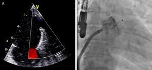 Assessment of left atrial appendage after implantation of closure device by color Doppler transesophageal echocardiography in mid-esophageal view at 42° (A) and by contrast fluoroscopy in anteroposterior view (B).
