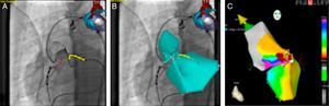 Reference fluoroscopic images on the Navigant workstation showing the coronary arteries (A) and left ventricular anatomy superimposed (B). Activation map showing earliest activation site (white dot) next to the right coronary artery ostium (C).